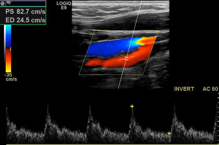 <p>Internal Carotid Artery on Doppler Ultrasonography