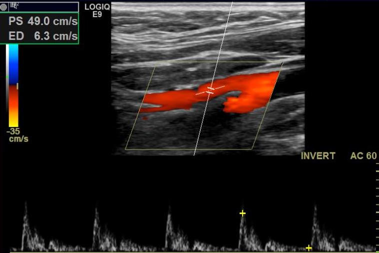 <p>External Carotid Artery on Doppler Ultrasonography