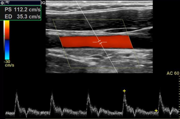 <p>Common&nbsp;Carotid Artery on Doppler Ultrasonography