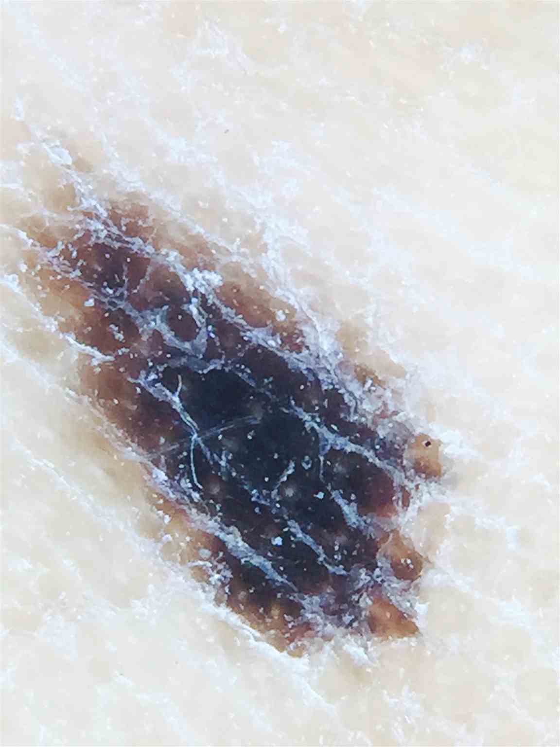 <p>Dermoscopy of Left Arch Nevus Exhibiting Parallel Ridge Pattern</p>