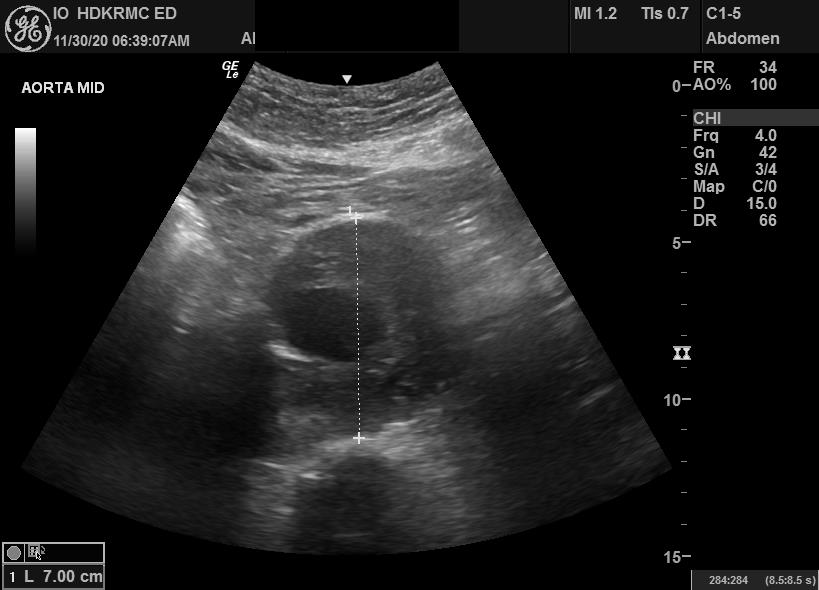 <p>Measurement of Abdominal Aortic Aneurysm