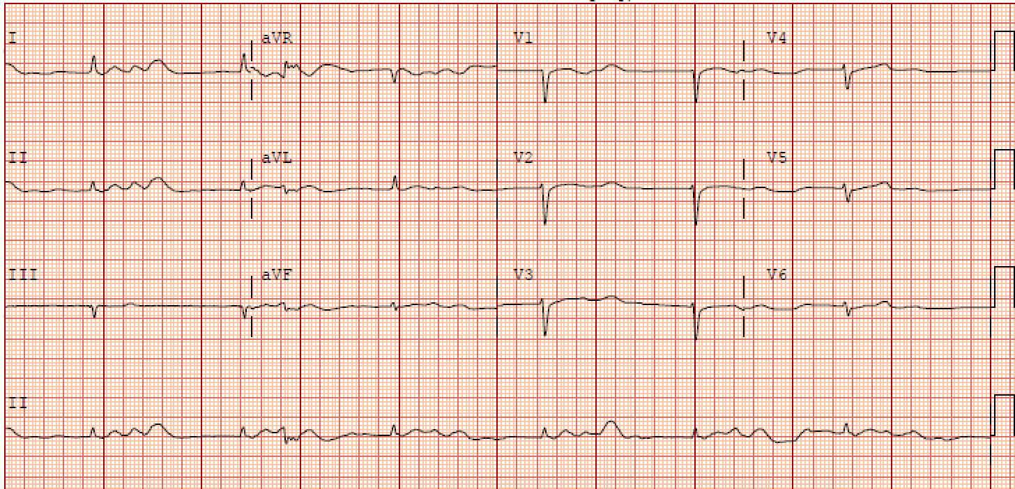 <p>Electrocardiographic Findings, BRASH Syndrome</p>