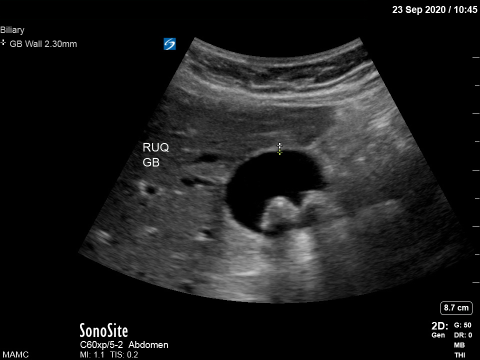 <p>Gallbladder Short Axis With Stones</p>