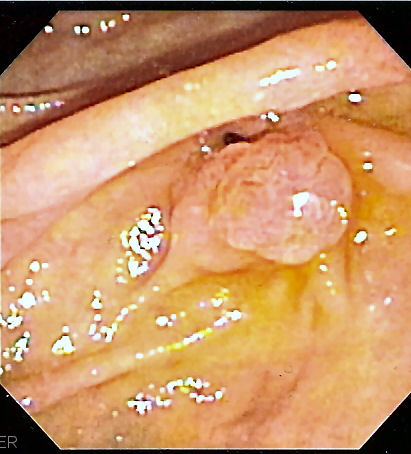 Endoscopic image of the ampulla of vater
