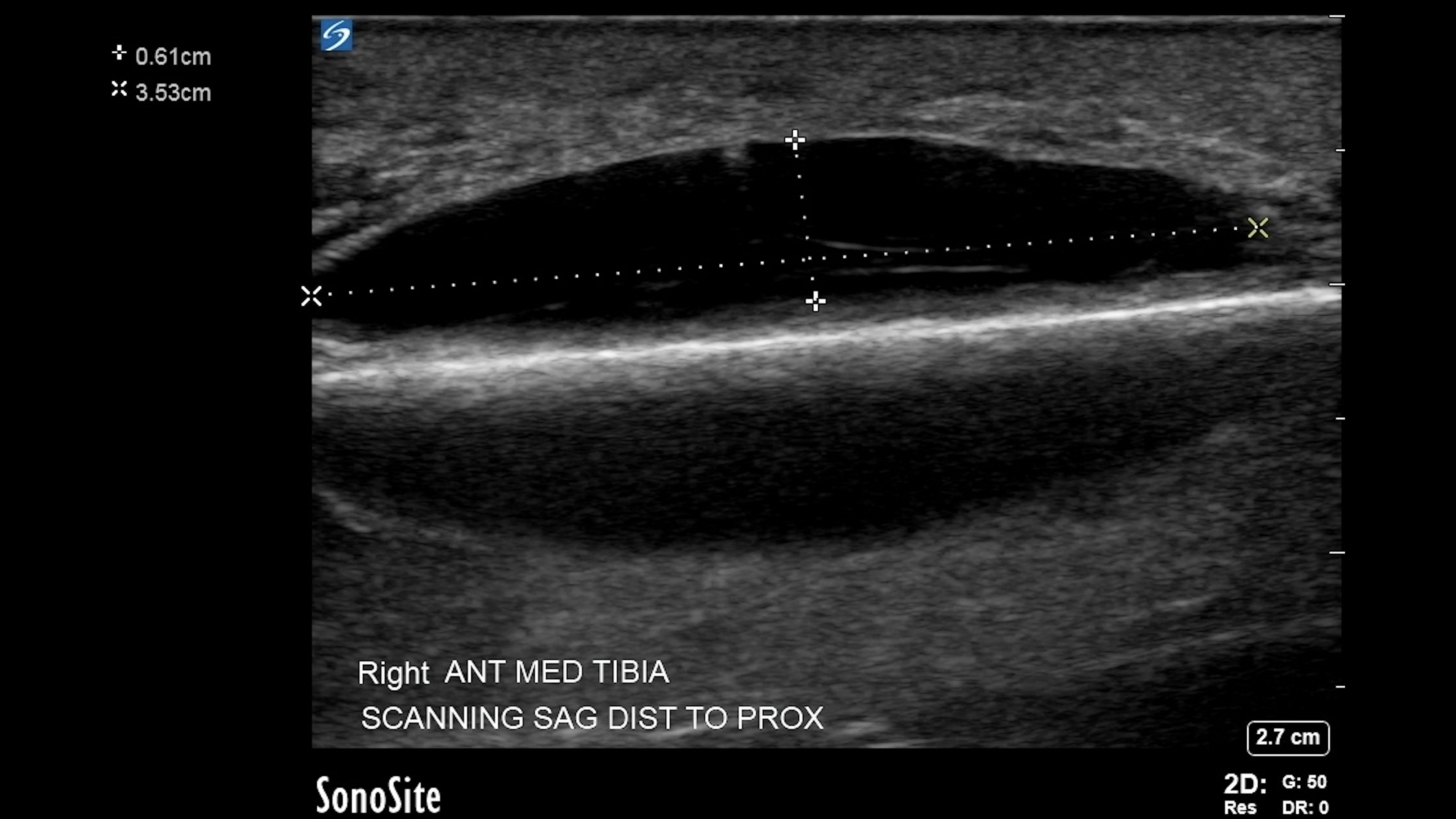 <p>Mirror Artifact. The image shows a mirror artifact along the anterior tibia behind a developing hematoma.</p>