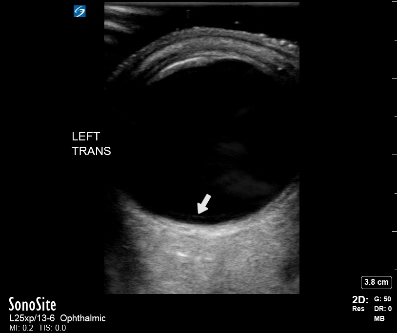 <p>Posterior Acoustic Enhancement Artifact Behind the Eye