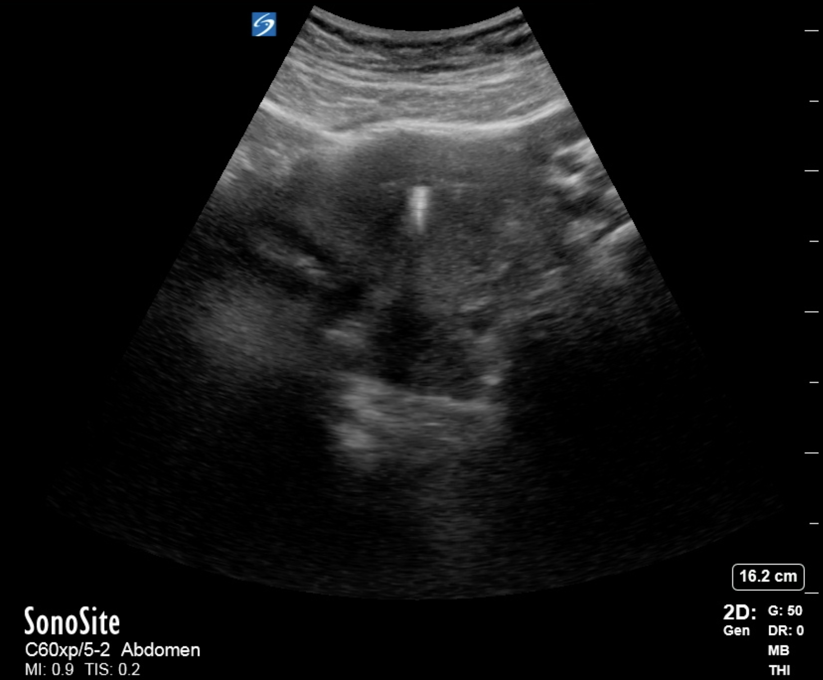 <p>Hyperechoic Reflection with Deep Shadowing