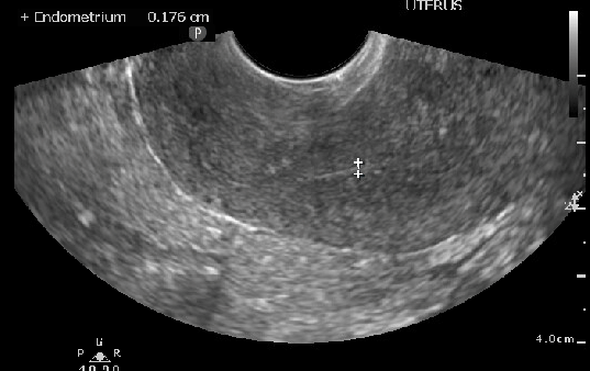 <p>Thin Endometrial Stripe in Postmenopausal Individual, Ultrasound