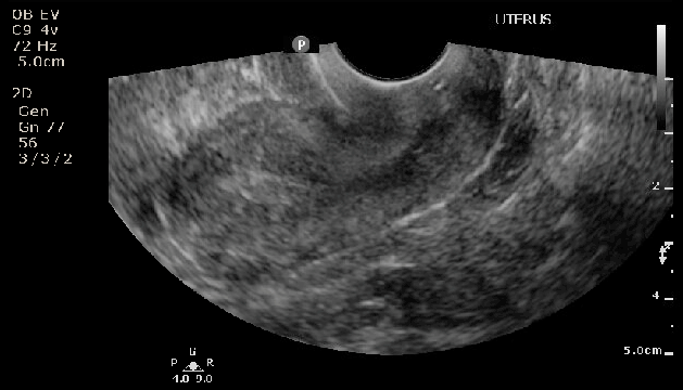 <p>Thickened Endometrial Stripe in Postmenopausal Individual, Ultrasound