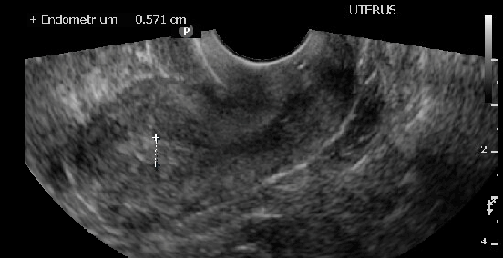 <p>Endometrial Stripe, Sagittal View of the Uterus on Ultrasound