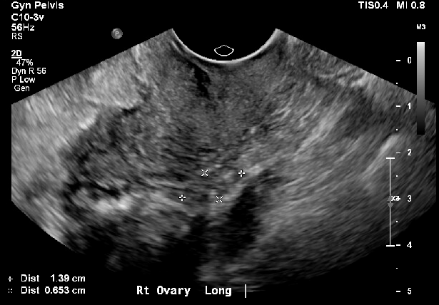 <p>Ovary With Small Follicles in Postmenopausal Individual