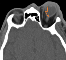 Retrobulbar hematoma with proptosis noted on CT imaging