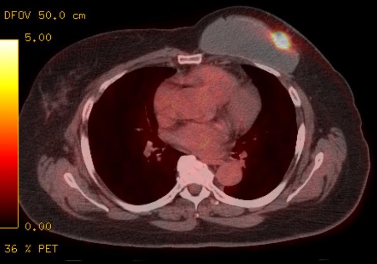 <p>Primary Cancer, Breast