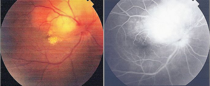 <p>Tuberculoma on Funduscopy