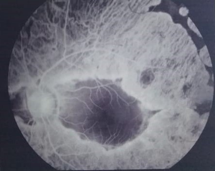 Fundus fluorescein angiography of a child with gyrate atrophy showing scalloped areas of retinal pigment epithelium and choriocapillaris atrophy with visible large choroidal vessels and macular sparing