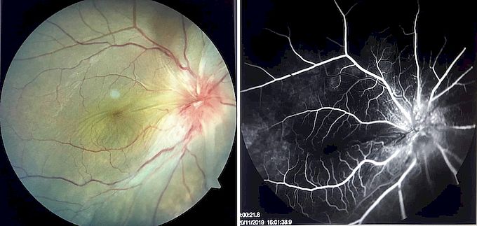 Color photography and fluorescein angiography of a case of optic disc granuloma in a patient with sarcoidosis