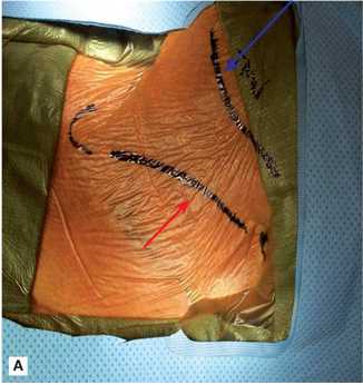 <p>Carotid Endarterectomy (CEA)