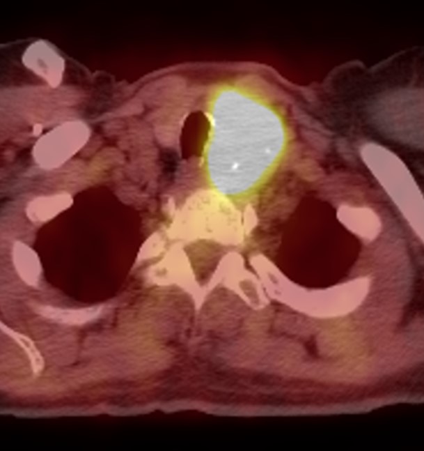 PET/CT Hurtle cell carcinoma 