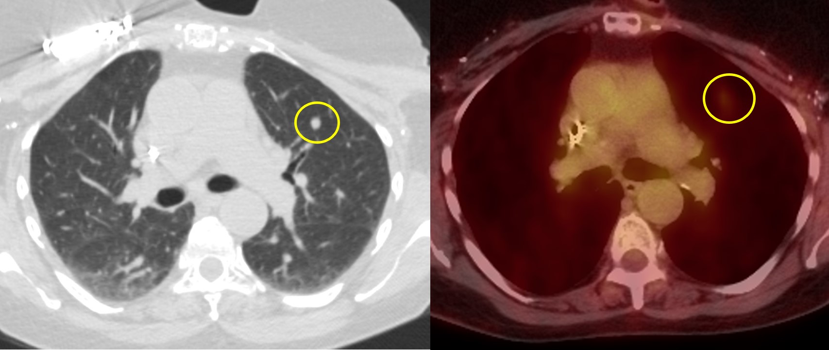 Previously treated papillary thyroid carcinoma with metastatic lung nodule without significant FDG uptake 