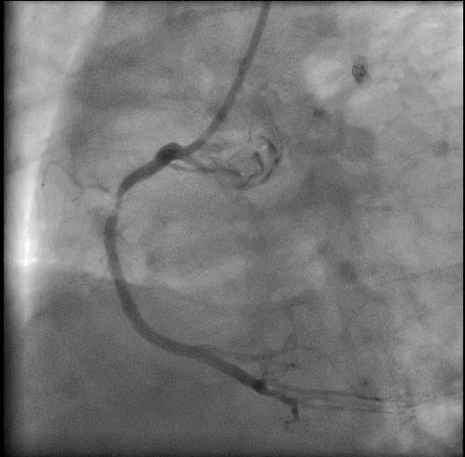 RCA lesion before angioplasty