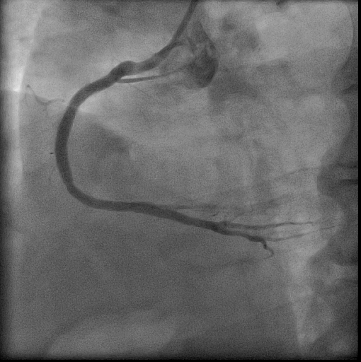 RCA lesion after percutaneous coronary intervention