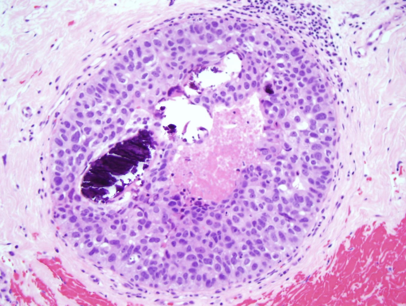 <p>Ductal Carcinoma