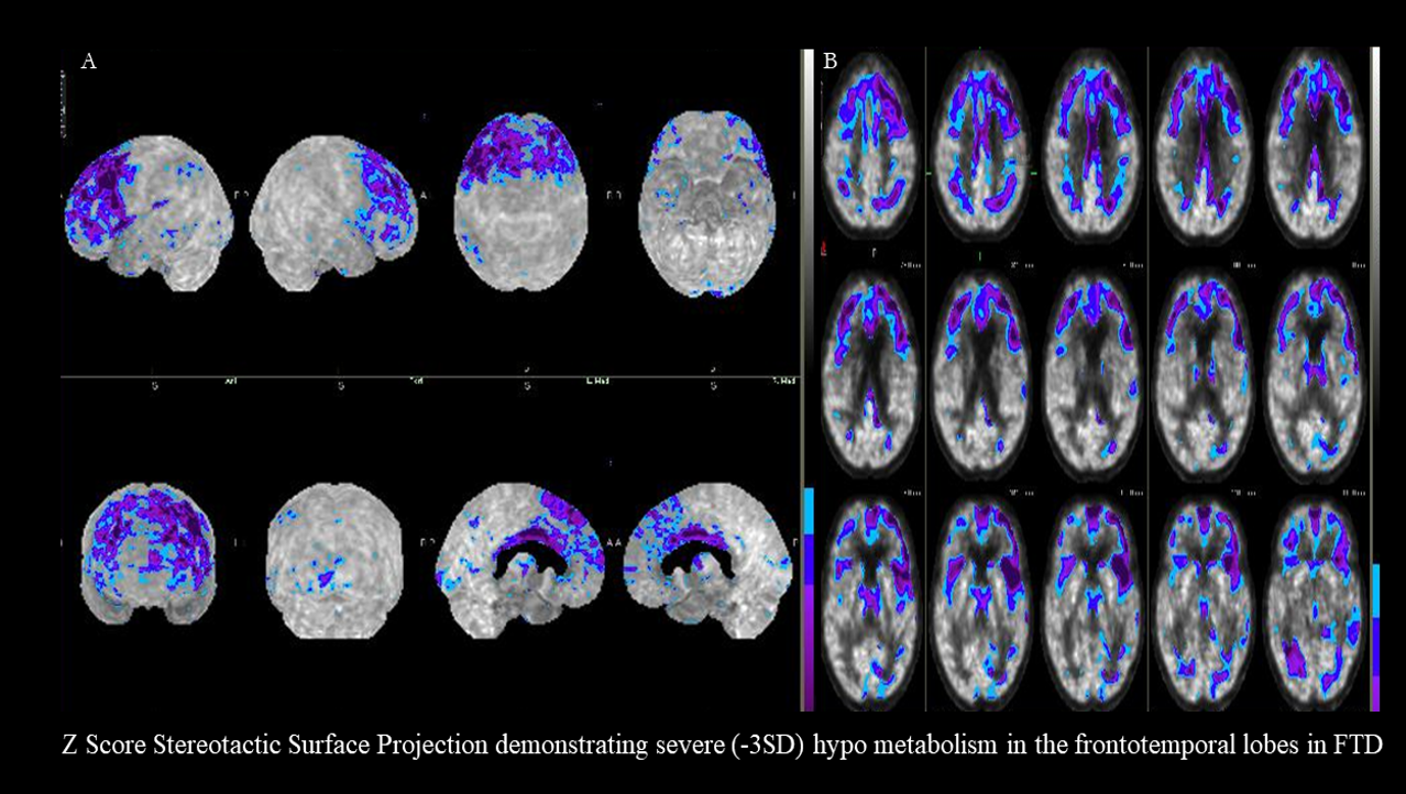 Frontotemporal Dementia