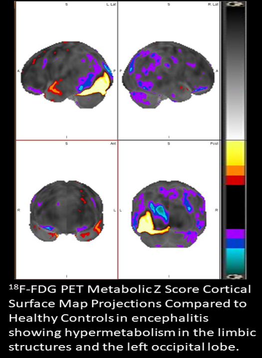 Encephalitis FDG PET