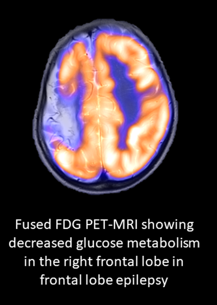 Epilepsy FDG PET