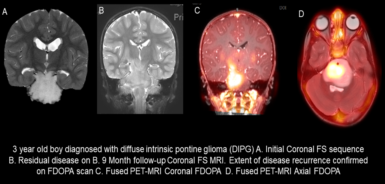 FDOPA Brain Tumor