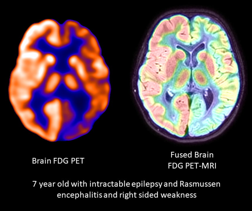 Rasmussen Encephalitis