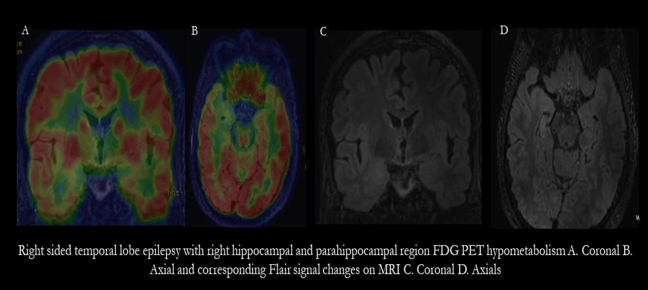 TLE Epilepsy