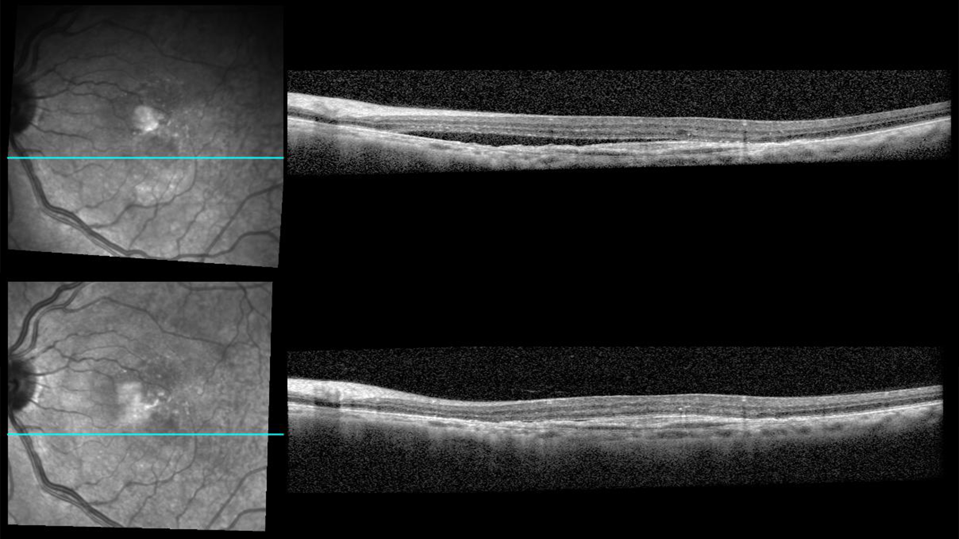 <p>Intravitreal Aflibercept Injection Result