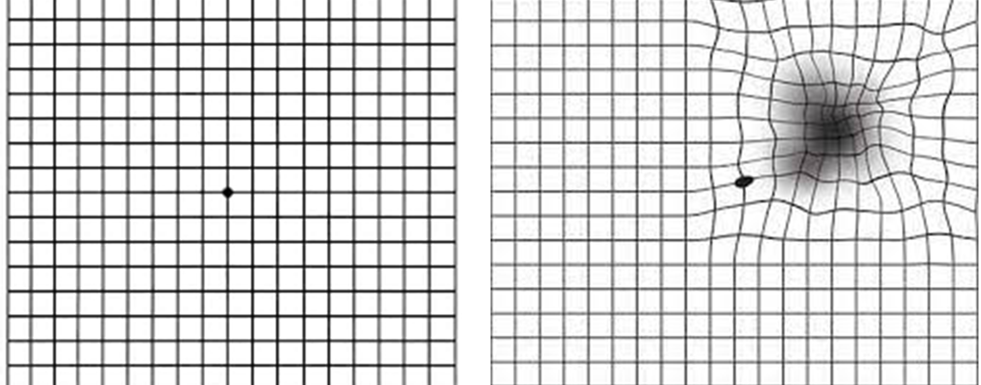 <p>Amsler Grid