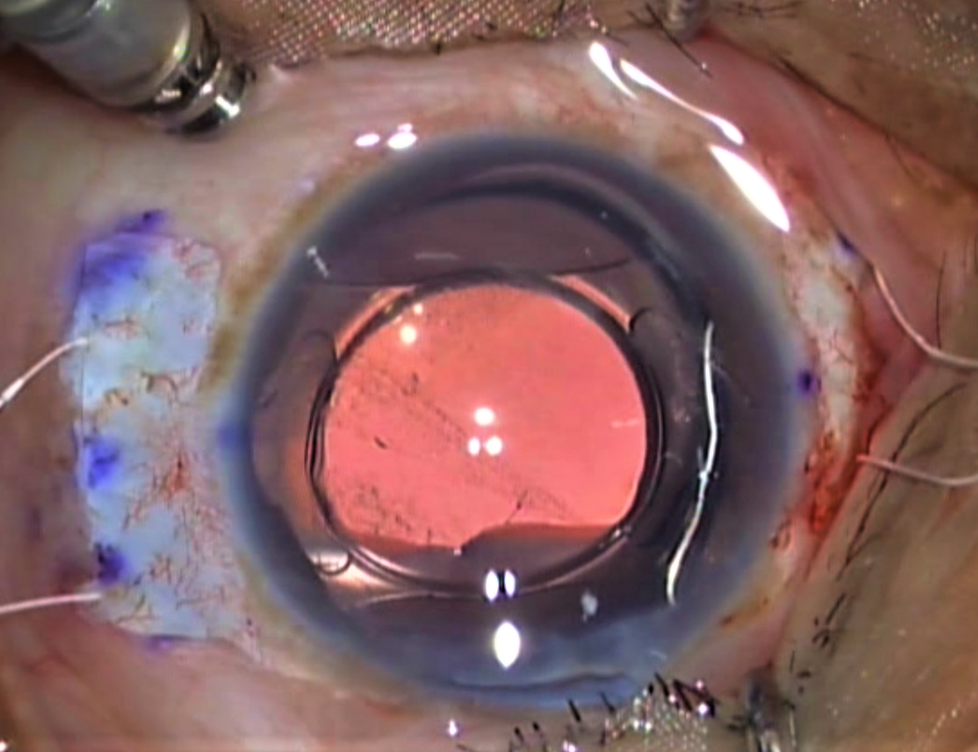 Externalisation of all four sutures in ab externo four-point fixation technique of SFIOL