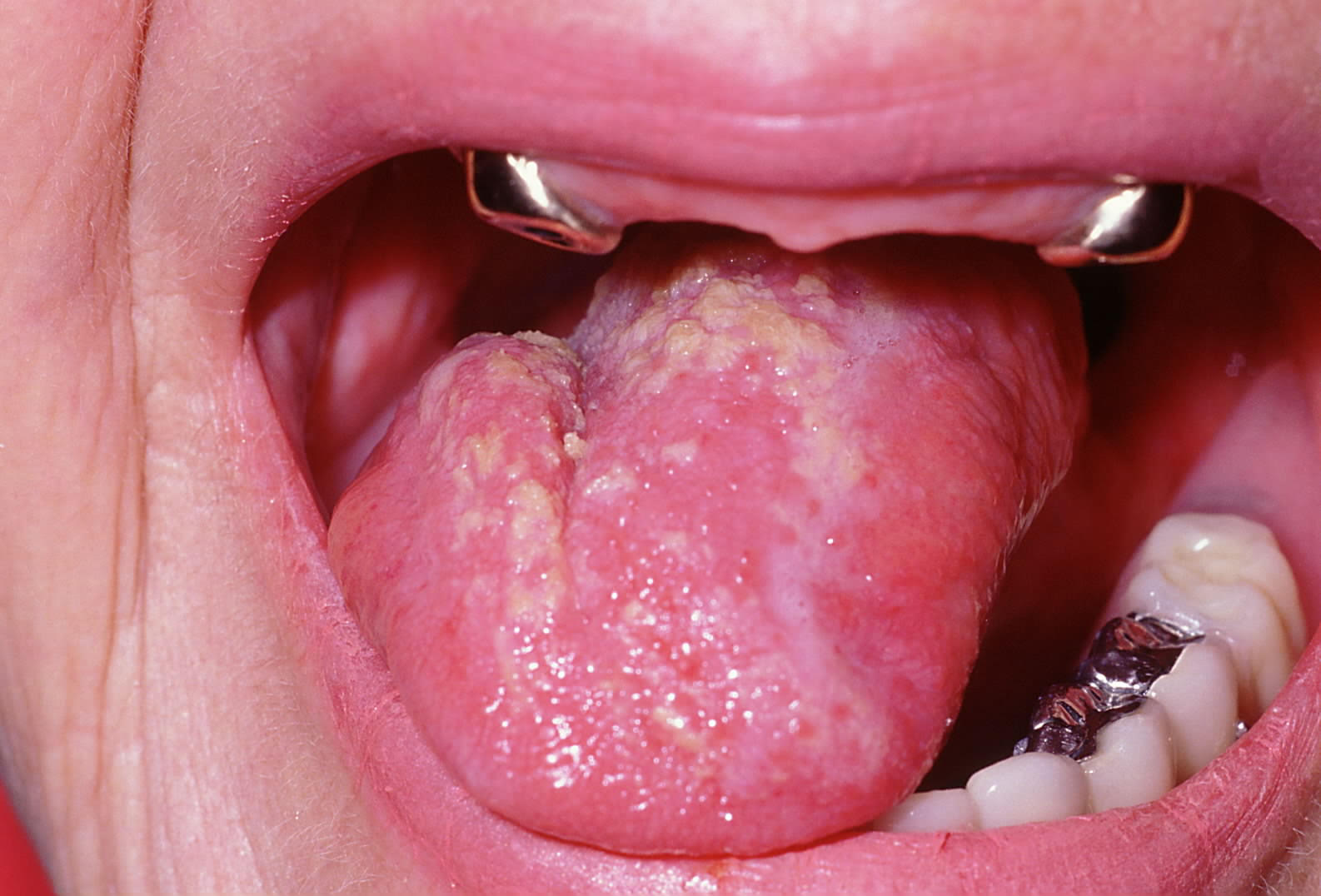 Candida albicans fungal infection on the dorsal surface of the tongue