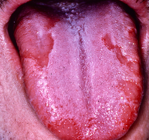 Geographic tongue (Erythema migrans) present on the dorsal surface of the tongue.