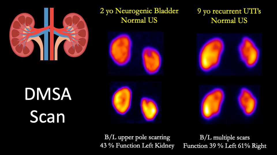 DMSA scan in pediatrics