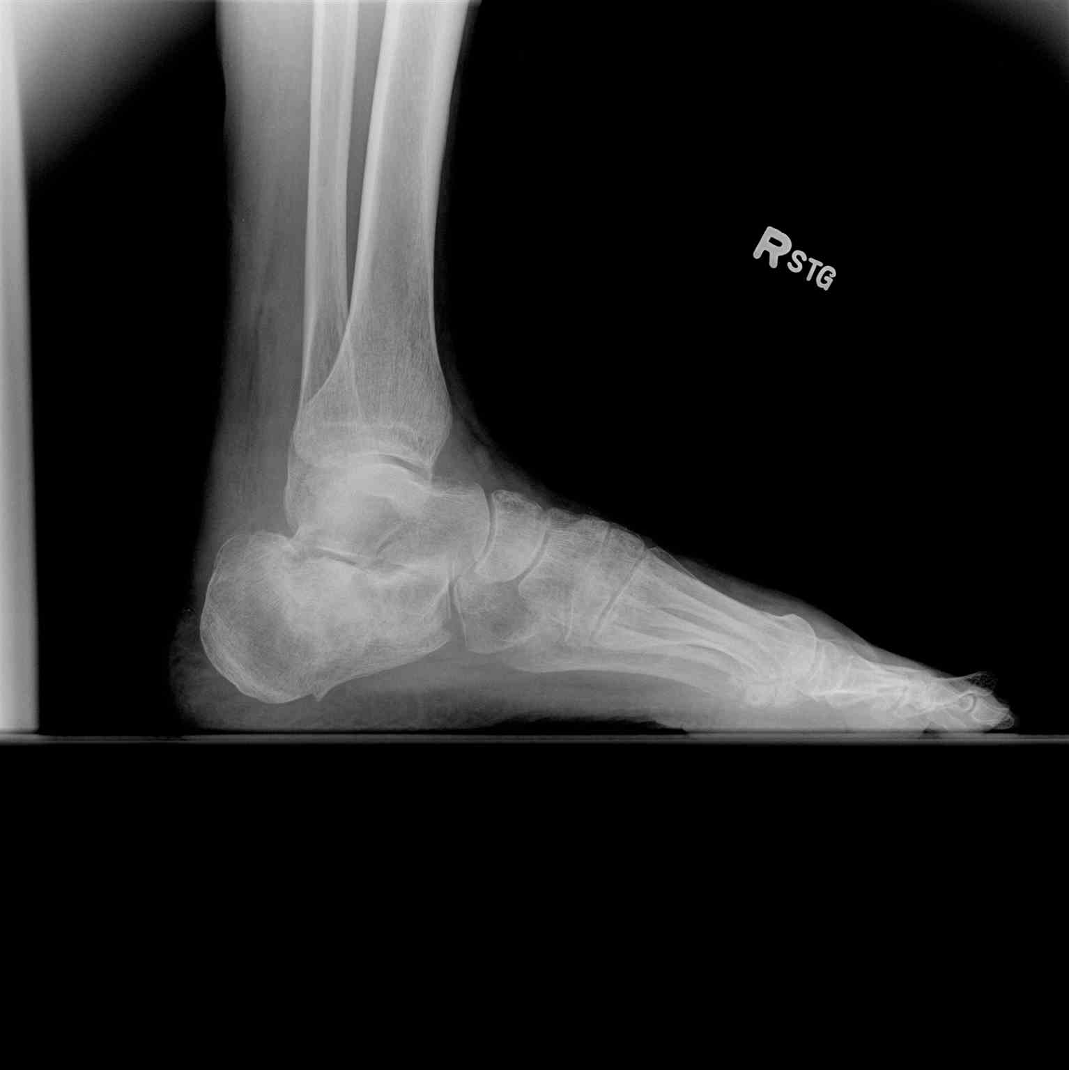 Ankle Radiograph Lateral Calcaneus Fracture