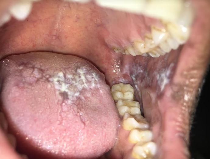 <p>Oral Lichen Planus</p>