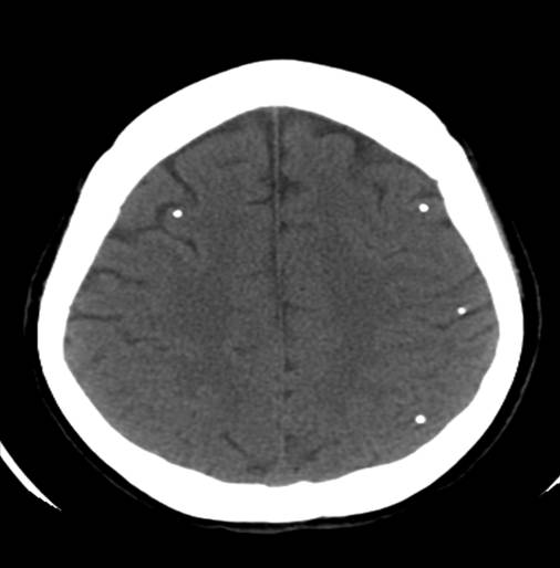 <p>Head CT,&nbsp;Neurocysticercosis</p>