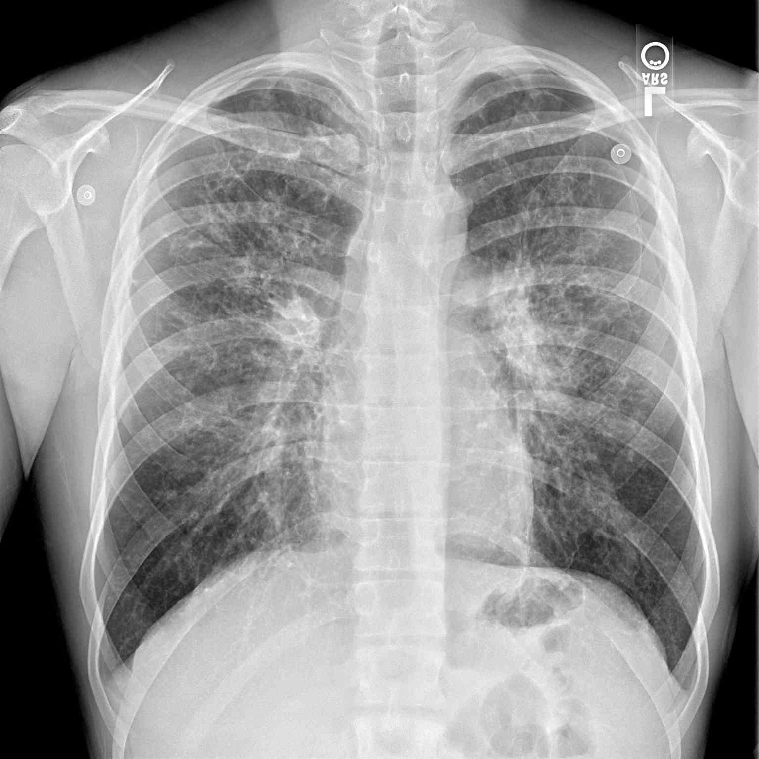 PA Chest Radiograph Cystic Fibrosis