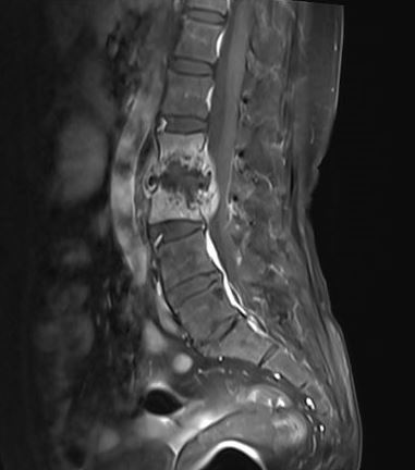 <p>Pott Spine</p>