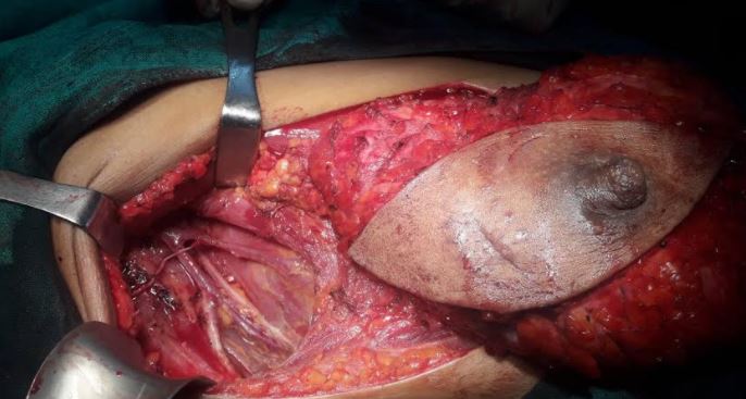 <p>Modified Radical Mastectomy