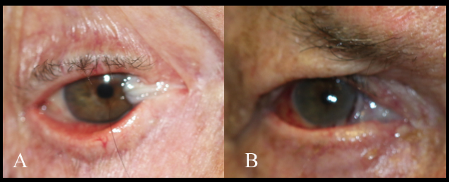 Split-thickness mucous membrane graft for reconstruction of medial cants and superior and inferior fornix