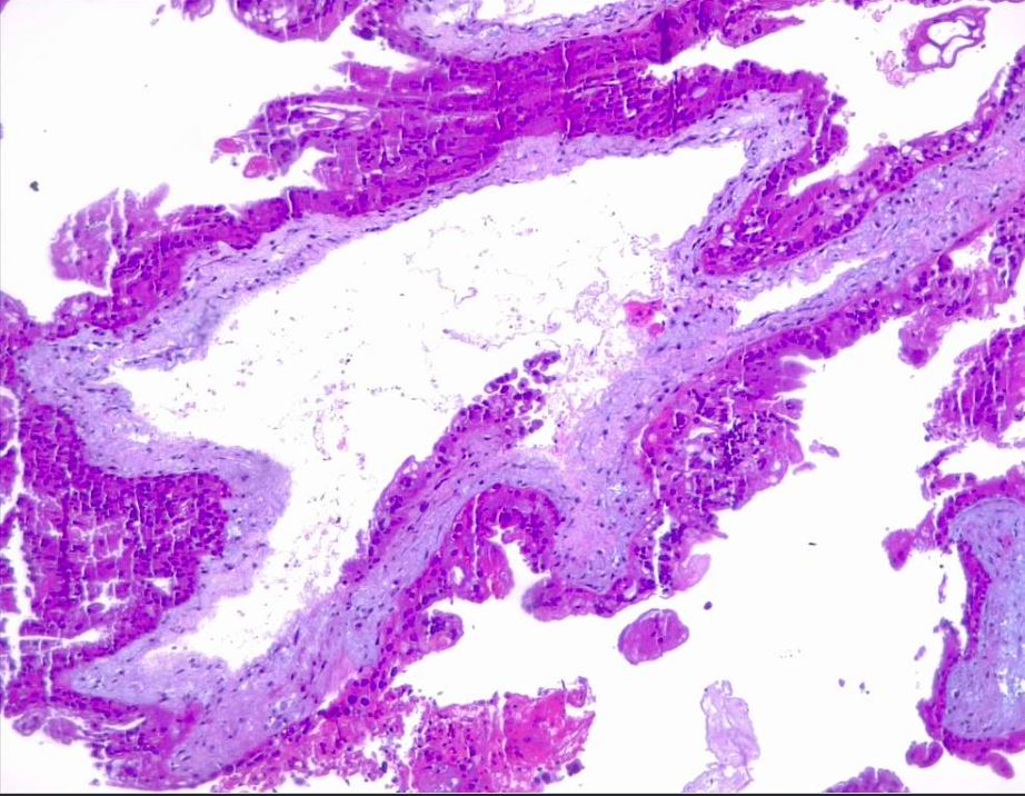 <p>Irregular, Indented Villi with Lace-Like Trophoblast Proliferation. Partial hydatiform mole, H/E 4x.</p>