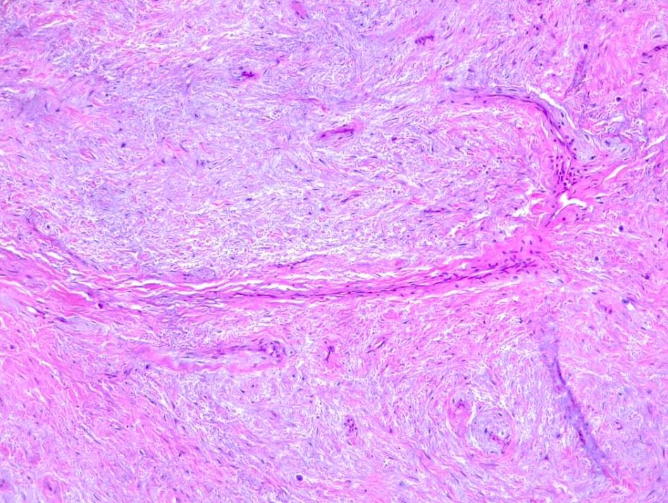 <p>Myxofibrosarcoma. Arciform vessels in a low grade sarcoma setting.</p>