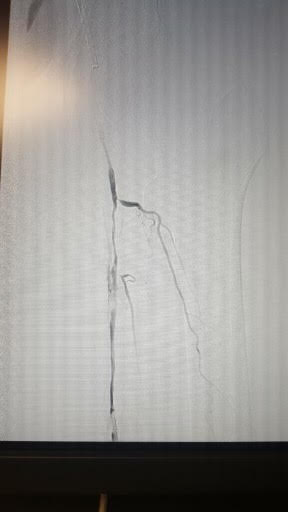 Peripheral Arterial Disease - Chronic Total Occlusion of Left Superficial Femoral Artery