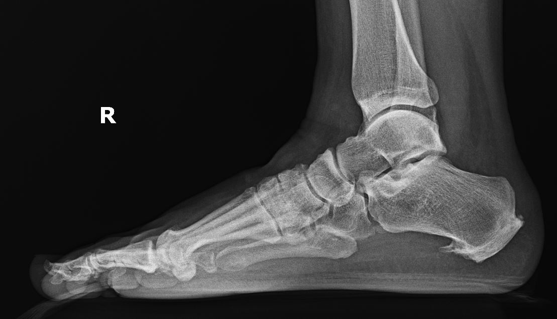 Plantar Heel Pain- note the large plantar calcaneal spur, commonly seen with plantar fasciitis and bursitis. In an older patient with plantar heel fat pad atrophy, the spur itself can be very prominent and painful.