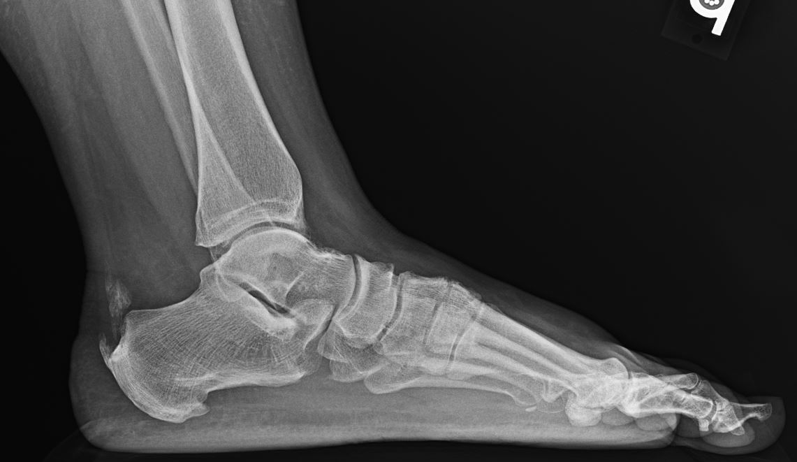 Hammertoe- an lateral radiograph demonstrating a mild 2nd digit hammertoe